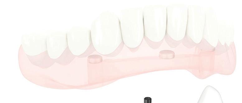 2 NobelProcera Implant Bar Overdenture NobelProcera Implant Bar Overdenture complete range of fixed and removable solutions. For a variety of attachment systems Suits every patient s needs.