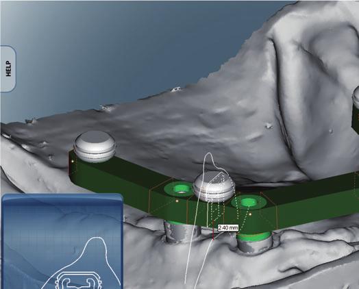 6 NobelProcera Implant Bar Overdenture NobelProcera Software designed by technicians for technicians.