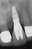 I remove the implant/abut/crown in one piece with my hands.