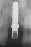 implant placement (= 1 surgery) Option 2: Early implant