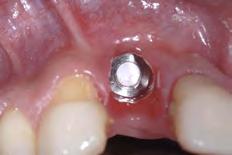 tooth loss (#11) Implant 11 was