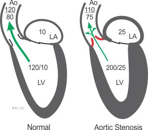 2. Aortic stenosis (AS) Due to the