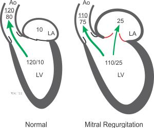 3. Mitral Regurgitation (MR) Looking at the cardiac cycle MR affects ventricular systole Blood not only ejects up the aorta but also back to the atria