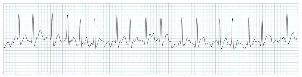 Heart rhythms To allow good filling and contraction heart rate is best between 50-100 resting Tachycardia common in atrial fibrillation