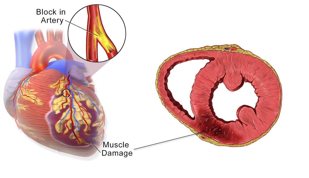 Myocardial infarction Patrick J. Lynch, medical illustrator; C.