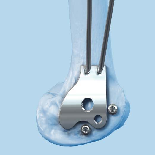 Reduce Articular Surface 4 Reduce articular surface Instruments 310.99 Countersink 324.170 Condylar Plate Guide, right 324.