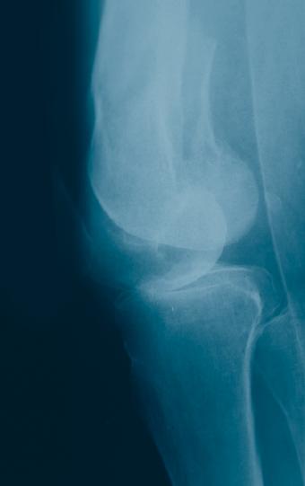 Malunions and nonunions of the distal femur Periprosthetic