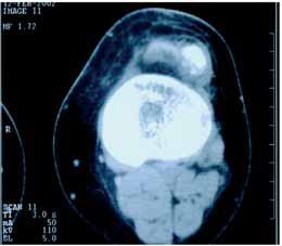 Samardziski M et al. / Intracapsular and para- articular chondroma of knee 207 Figure 2b. Case 2. CT scan of the same knee: encapsulated ossified mass. Figure 3a. Case 3.