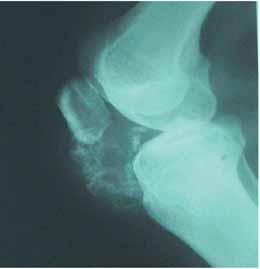 History of the patient showed that she had slightly painful, slowly growing lump seated beneath and laterally of the patella for more than 30 years (Figure 4a).