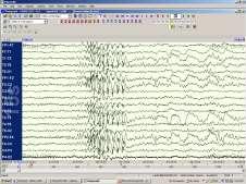 Seizures EEG-Polysomnography for Nocturnal Events Sleep Terrors (night terrors) Sleep Walking Head Banging Cell