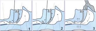 Continous Positive Airway Pressure provides - Open upper
