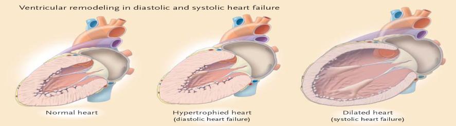 How obstructive SA can contribute to CHF -