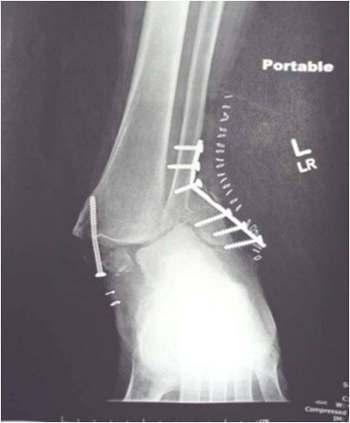 The Foot and Ankle Online Journal Figure 2 Clinical photograph of the exposed distal tibia and calcaneus in case # 1.