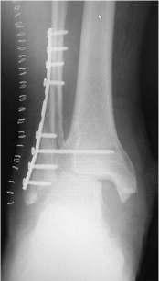 One week later, he had a septic ankle arthrodesis and subtalar joint arthrodesis using the Ilizarov frame as well as a rotational flap to close the ulcer at the ankle. (Figs.