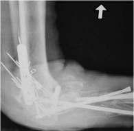 Singh, Kim, Dailey, Truong, Mejia A B Figure 14A and 14B Severe foot and ankle deformity with sepsis at the tibial talar joint and failed hardware. (A) Note the probe in the medial ankle.