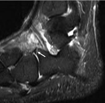 calcaneus (arrow). There is no bone marrow edema adjacent to the fracture line indicating this is a previously missed subacute fracture. 29A 29B Fig 29. Os Trigonum syndrome and posterior impingement.