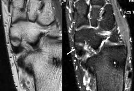 This type of fracture usually is very subtle and requires CT or MRI evaluation (Fig 28). Accessory ossicles a. Os Trigonum. There are many accessory ossicles in the region of ankle and foot.