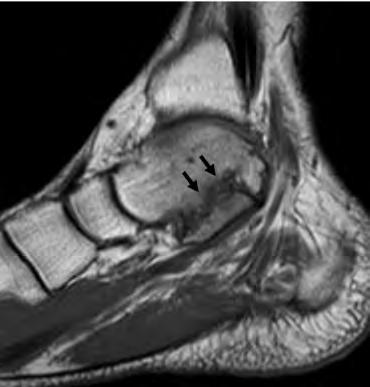 Type I, or Os tibiale externum, is a sesamoid bone within the posterior tibialis tendon near the navicular insertion.