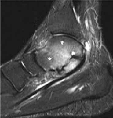 The majority or entire tibialis posterior tendon inserts on the type II accessory ossicle. The type III accessory navicular, or cornuate navicular, is a prominent navicular tuberosity.