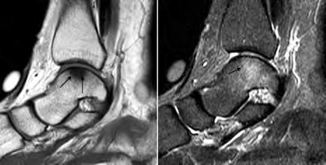 磁共振成像 2010 年第 1 卷第 6 期 Chin J Magn Reson Imaging, 2010, Vol 1, No 6 海外来稿 Overseas Papers Osteochondral lesion of the talus (OLT) Osteochondral lesion of the talus is the preferred term.