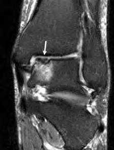 MRI features include focal bone marrow edema in the talar dome starting at the subchondral region, subchondral cystic formation, subchondral fracture, articular cartilage thinning, bowing, or