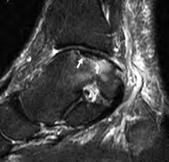 MRI show bone marrow edema (Fig 33). 33A Fig 33. Osteochondral lesion of the talus, Stage I.