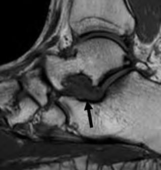Osteochondral lesion of the talus, Stage III.