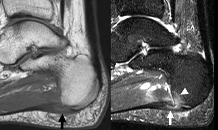 (a) Sagittal T1, (b) sagittal T2 weighted with fat saturated images showed moderate thickening of the proximal plantar fascia near the origin with increased