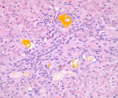 Proliferation of bile ductules at the edges of portal