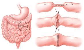 Strictureplasty Does not remove intestine but remodels it When?