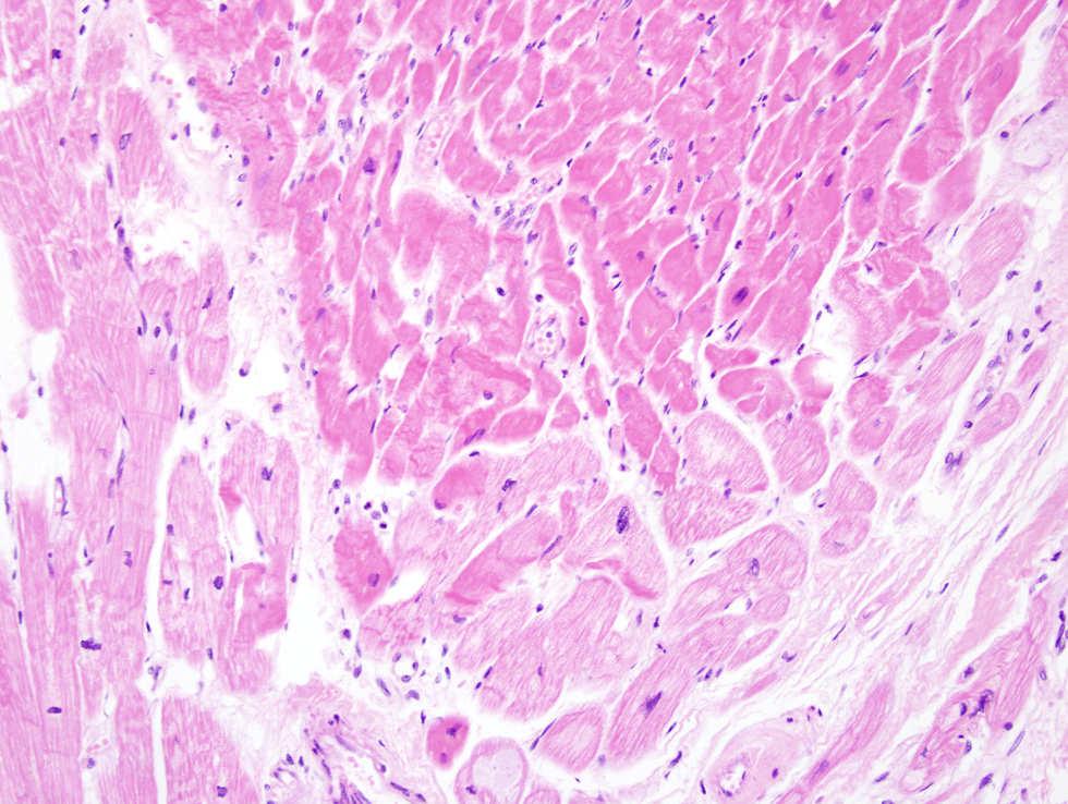 Coagulative Necrosis Hypereosinophilia (above) with intense pink cytoplasm No