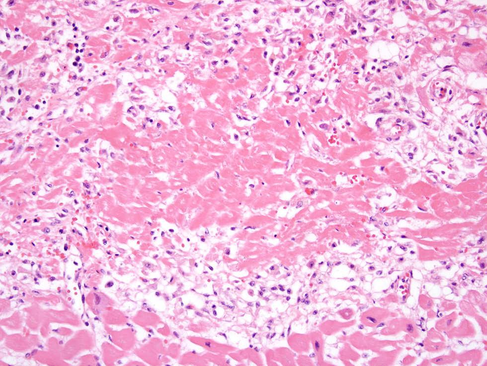 Coagulative Necrosis Healing myocardial infarct 8 days old Chronic inflammatory cells at border of