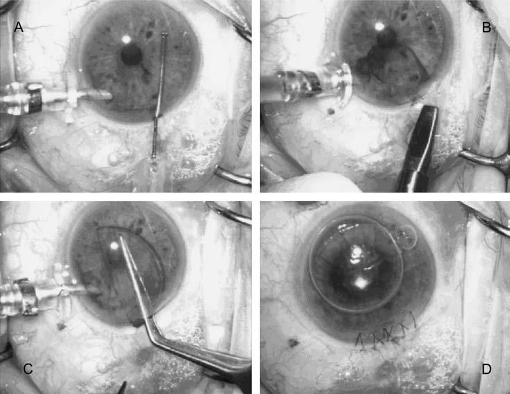 Mearza et al Cornea Volume 26, Number 3, April 2007 surgeons and had undergone wet-laboratory DSEK training, and one had assisted in DSEK surgery with another surgeon before the study.