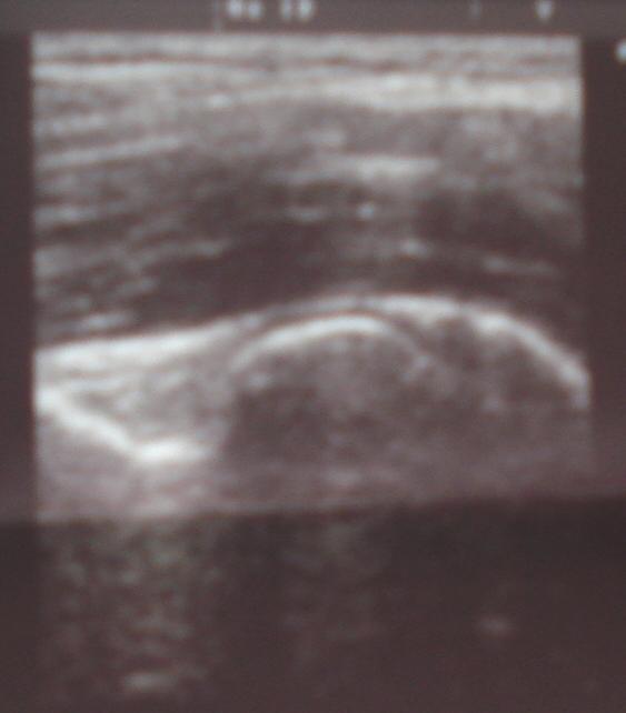 Ultrasound images of supracondylar fractures of the humerus, showing the anterior
