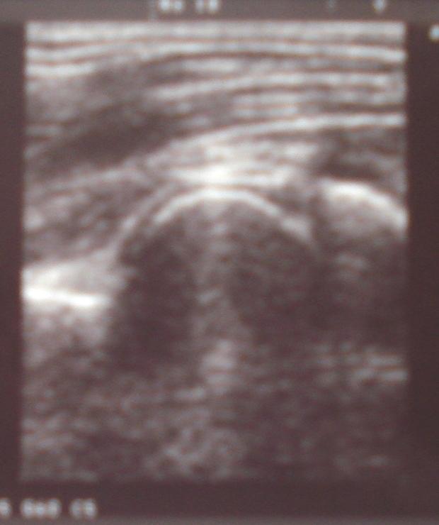 The le; image shows the lateral condyle (green asterisk) and the radial head (red