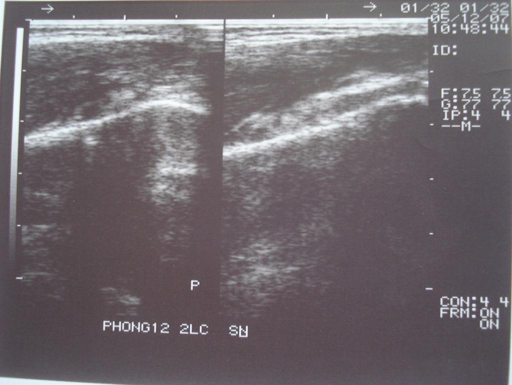 Ultrasound image of the posterior aspect of the
