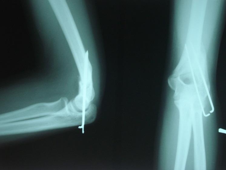 removal X-rays