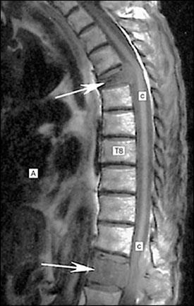 Investigations & information needed prior to Rx 1. MRI scan of the whole spine multiple levels 2. Knowledge of cancer type & stage 3.