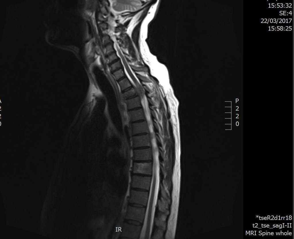 MRI MRI 22 03 17 Summary Multiple spinal mets Cord compression at T2