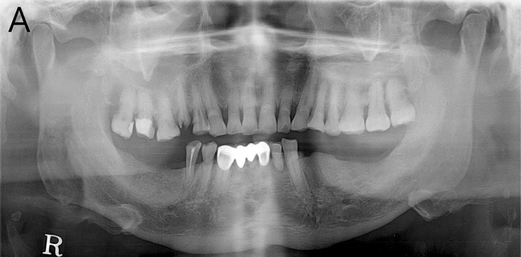 swelling on buccal side. On electric pulpal testing, the upper right first molar showed normal tooth vitality. All teeth showed negative response on percussion and grade I mobility.