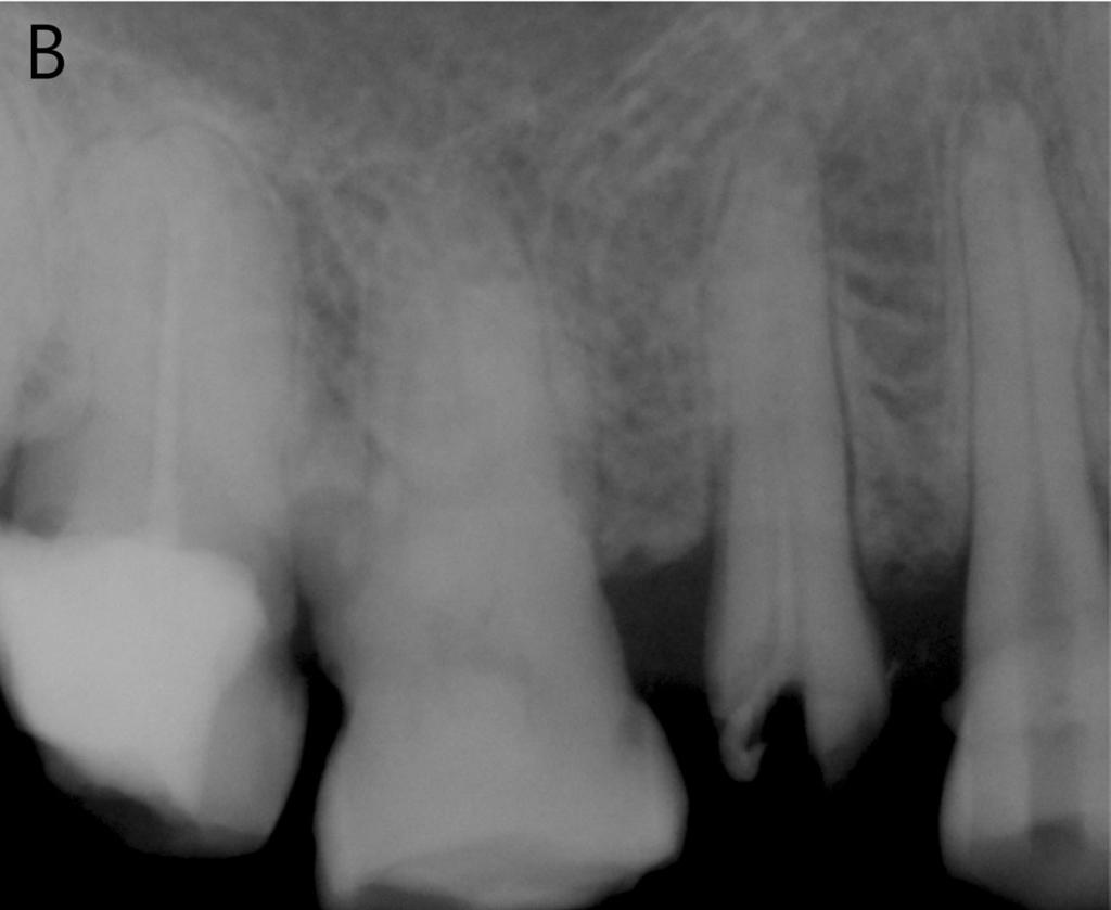Intraoral radiographic image showed alveolar bone loss and periodontal ligament space widening of the upper right second premolar(fig. 1b).