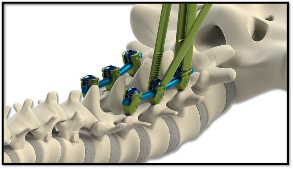 TiLock XT Minimally Invasive Surgery (MIS) Pedicle Screw System The Genesys Spine TiLock XT Minimally Invasive Surgery (MIS) Pedicle Screw System consists of rods (straight and curved), lock screws,