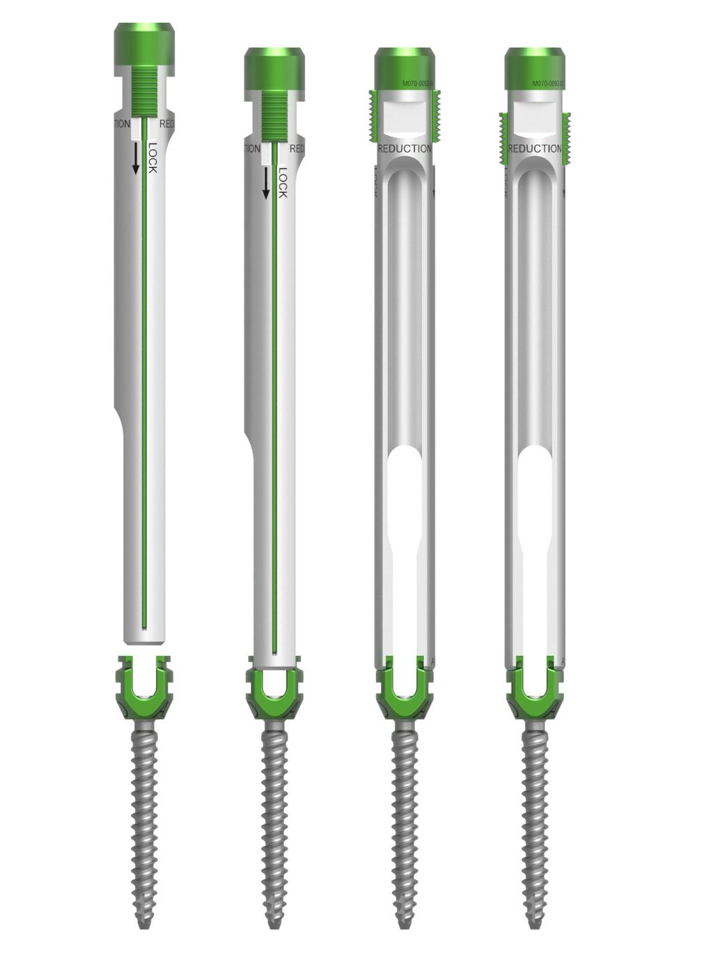 Rod reduction is described further in Step 11. To attach a screw extender to a pedicle screw: Select appropriate size pedicle screw.