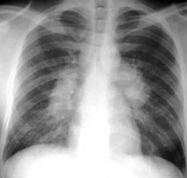 Figure 2: Radiographic appearance in sarcoidosis. Figure 3: X-ray showing bilateral and symmetric hilar and paratracheal lymphadenopathy.