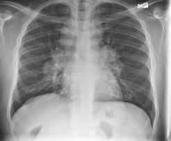 In the plain radiograph, the most common manifestation is bilateral hilar and mediastinal nodal enlargement, which is seen at some stage during the illness [1].