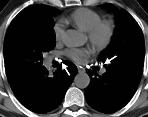 in the bronchovascular sheath and, to a lesser extent, in the interlobar septa and pleura. This distribution is one of the most helpful features in recognizing sarcoidosis pathologically.