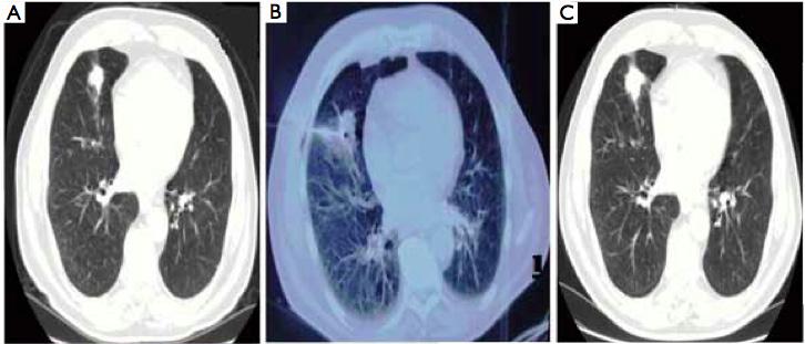 72 Tsakiridis et al Surgery for pulmonary metastases of RCC A B AC D E Figure 2 Serial CT imaging of the tumor, within a period of two years Despite negative for malignancy CT guided needle biopsy,