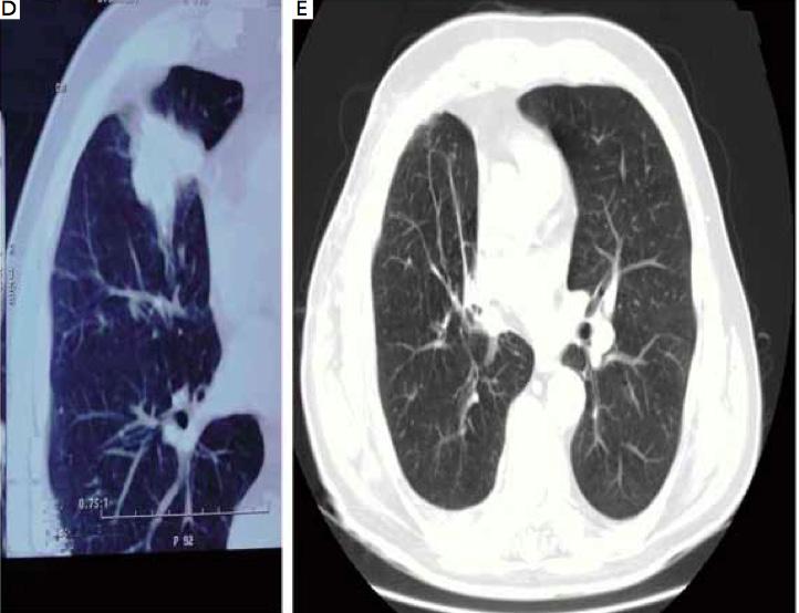Carcinoma, maximal tumor diameter 35 cm; B CT guided needle aspiration [2010]; C Follow up chest CT in 2011, tumor size somewhat increased (fuller contour, without significant change in maximal