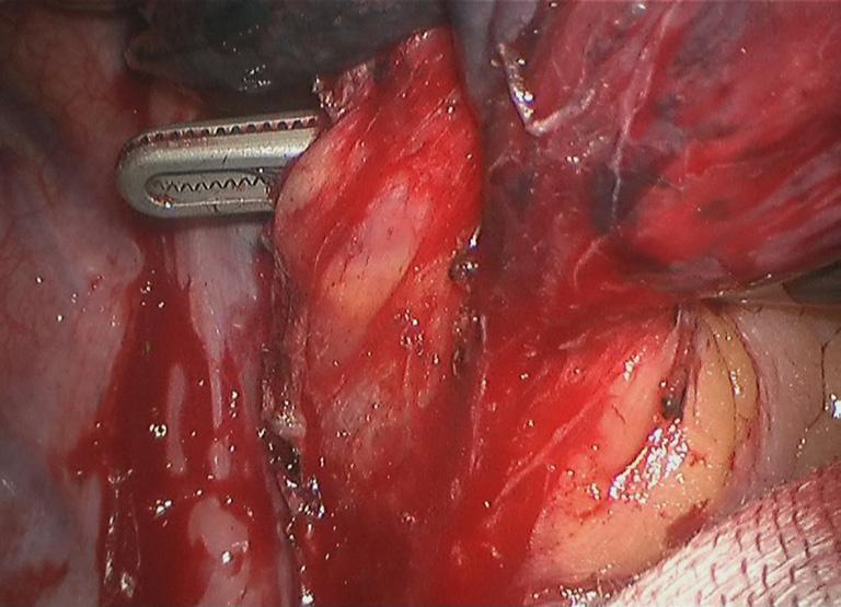 Figure 9 Pull the inferior pulmonary vein using an elastic cuff: markings.