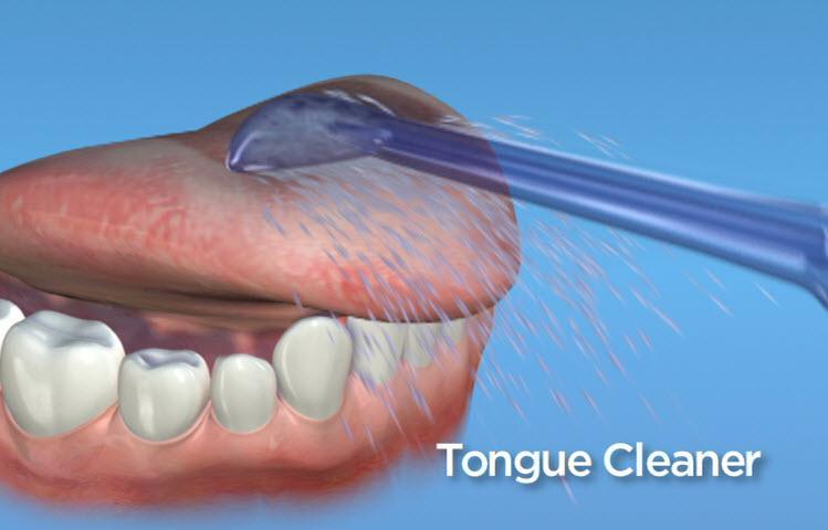 Powered Tongue Cleaner Attachments - Provides a flushing action, removing plaque and debris from the dorsum of the tongue - Can be used to deliver an antimicrobial - Can